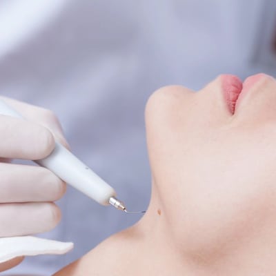 Wart Removal